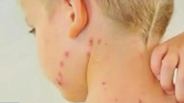 Measles case confirmed on Long Island, 12 potential exposures identified