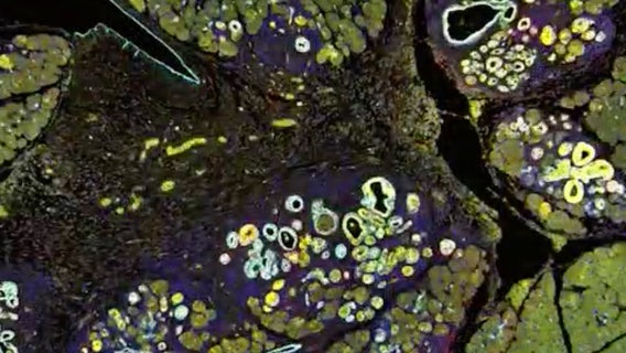 Researchers at Long Island lab discover breakthrough that slows pancreatic cancer progression