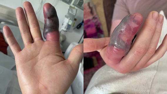 NJ venomous snake bites cyclist who tried to help: 'My hand was just too close'