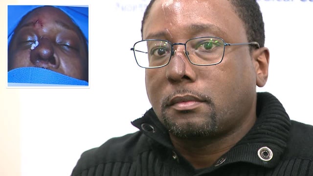 Long Island man who lost nose protecting girl gets reconstructive surgery: 'I feel like before'