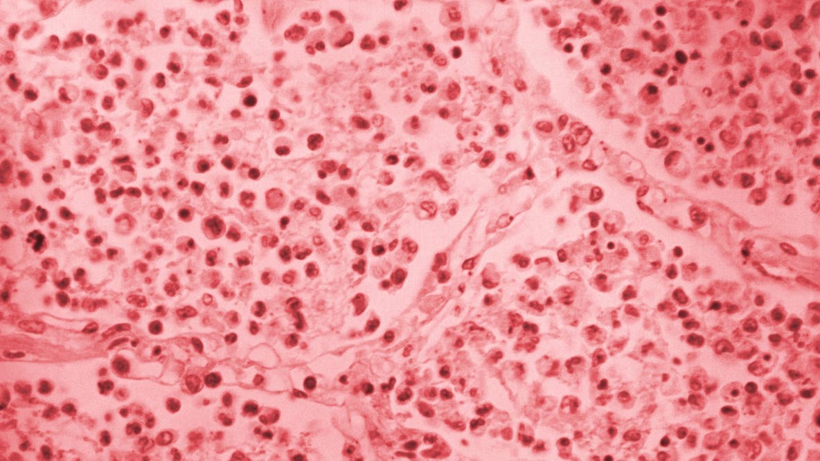 Upper East Side Legionnaires’ outbreak jumps to 54 cases as cooling towers investigated