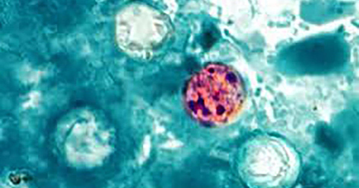 Mapa da doença Cyclospora: 29 estados atualmente investigando doenças diarreicas, incluindo Nova York, Nova Jersey