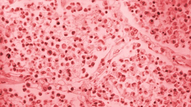 Upper East Side Legionnaires’ outbreak jumps to 54 cases as cooling towers investigated