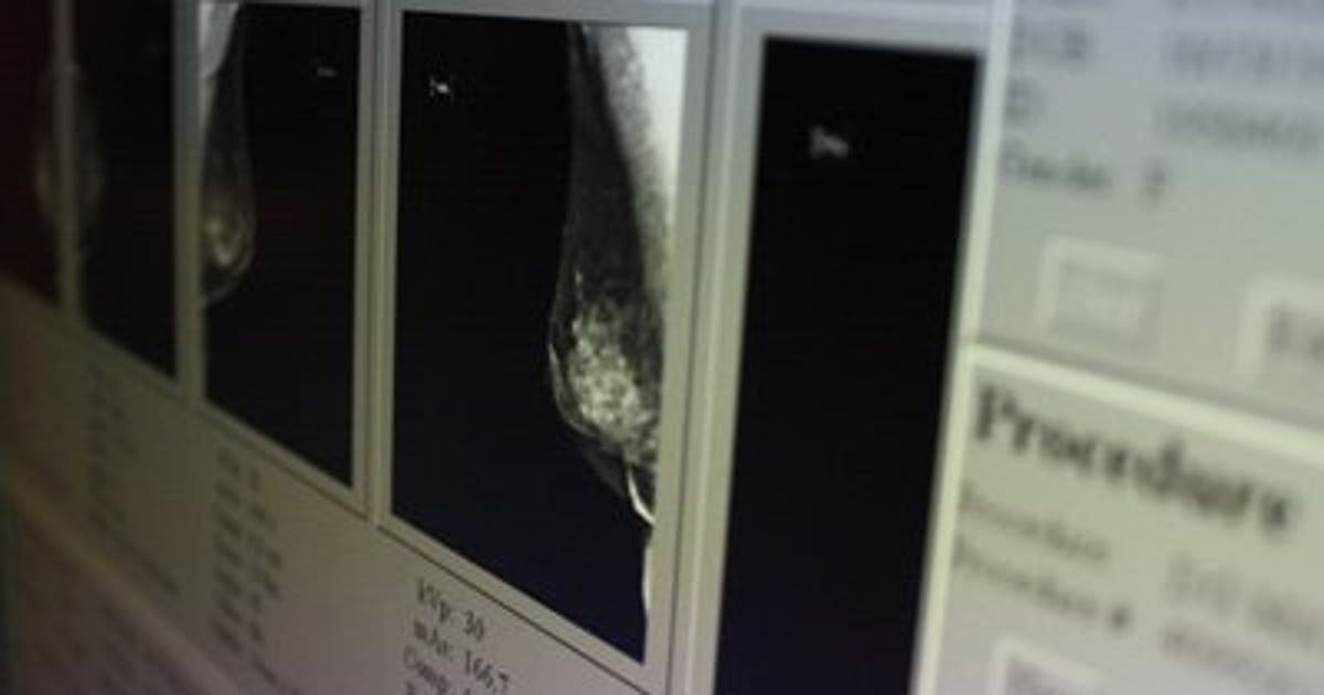 CDC: Breast cancer more deadly in black women | FOX6 Milwaukee
