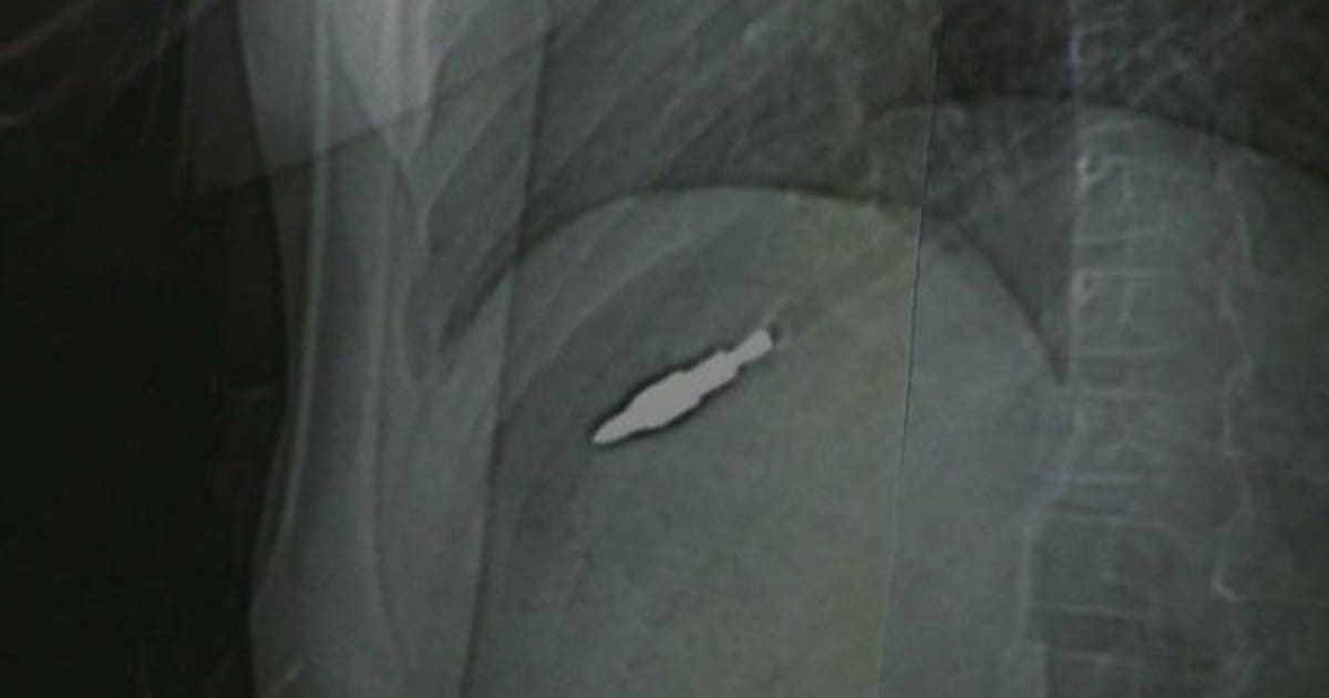 Mother of girl shot and wounded by arrow talks about incident | FOX6 ...