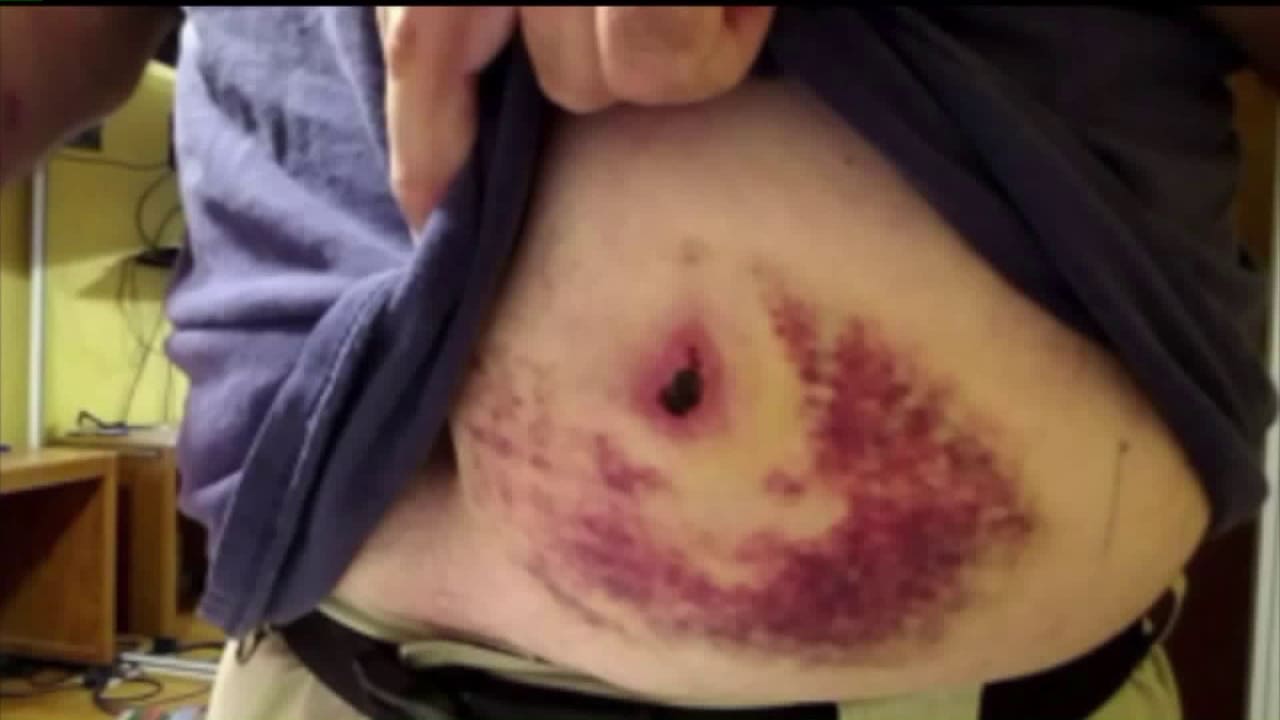 Officer shares photo of bruise caused by bullet that struck his