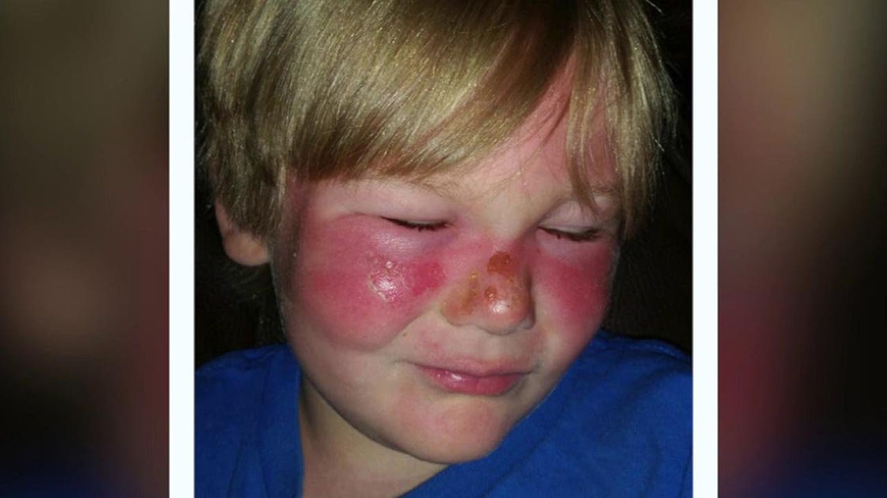 sunscreen for burn victims