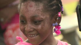 Balloons released to celebrate 5-year-old fire victim's release from hospital