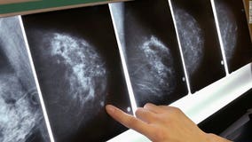 US OKs 1st drug aimed at women with inherited breast cancer