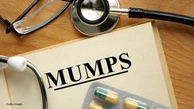 MU student has confirmed case of mumps; 6 total cases in Milwaukee in 2017