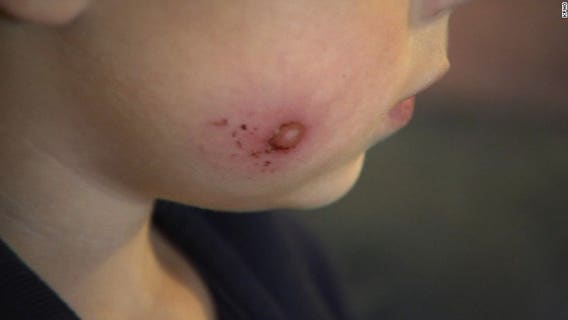 5-year-old boy has nightmares after someone fired paintballs, injuring him during Trick-or-Treat