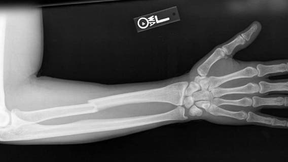 Insurance fraud: Man submits $900K worth of claims...and we're all paying for it