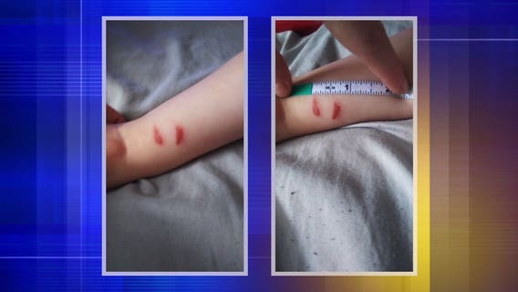 4-year-old boy comes home from school with gashes on wrist, mom says 'he was too scared' to say anything