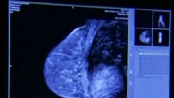 Mammograms or not?