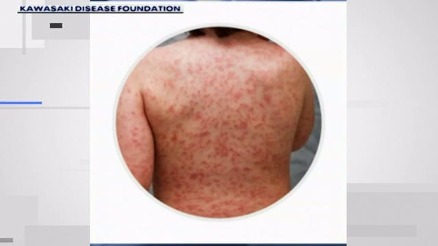 Children’s Wisconsin IDs state’s 1st suspected cases of Multi-System Inflammatory Syndrome in Children