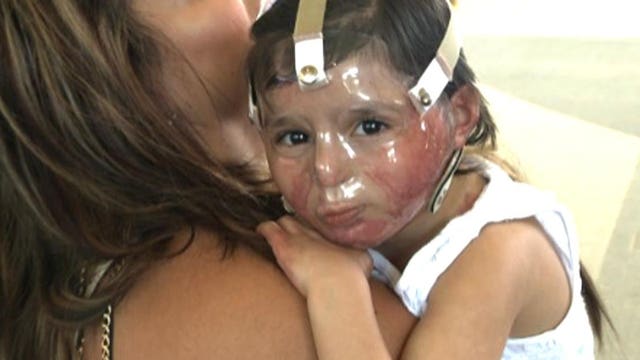 5-year-old faces Halloween one year after tragic pumpkin lighting accident