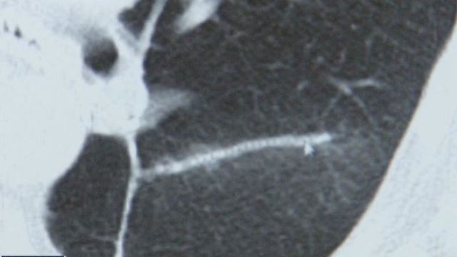 Woman 'devastated' to learn her cancer went from Stage 1 to Stage 4 during COVID lockdown