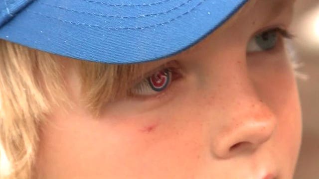 Seven-year-old cancer survivor shows Cubs pride with prosthetic eye