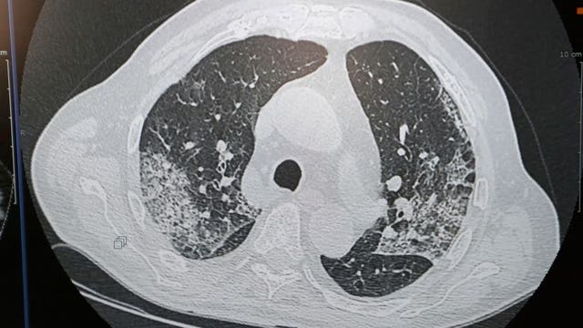 Beyond the symptoms, doctor breaks down what COVID-19 does to the body