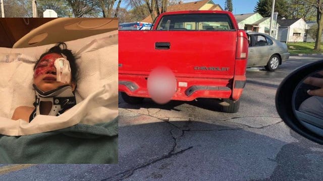 Police: Man arrested in hit-and-run crash that may have cost 7-year-old girl her eyesight