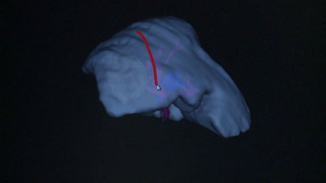 Life-saving technology: Doctors use "human GPS" to map out surgeries