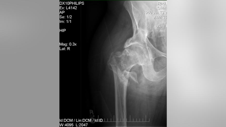 HipFracture_Xray