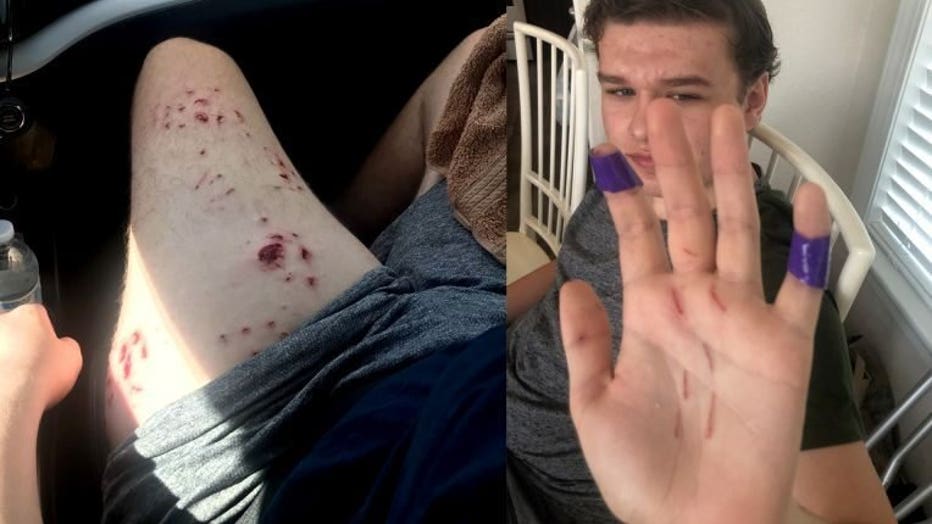 Teen, father fight off shark at North Carolina beach
