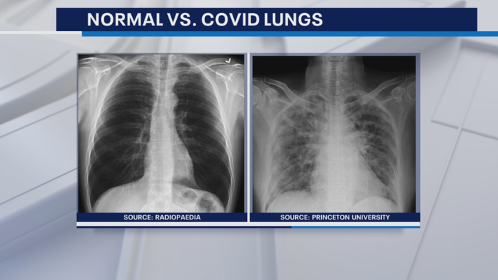 Doctor: Most 'probably won't' have long-term lung scarring after COVID - Vimarsana News