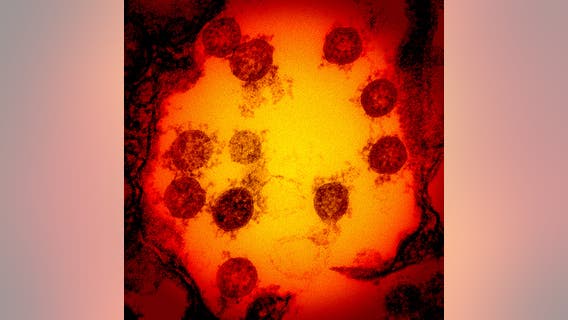 Cholesterol drug cuts coronavirus infection by 70%, researchers find