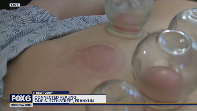 Connected Healing: Benefits of acupuncture