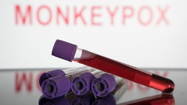 Monkeypox: 1st case in Milwaukee resident, health officials say