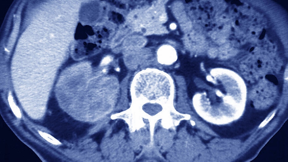 renalcarcinoma