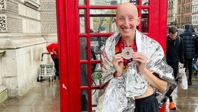 Marathon runner with alopecia bullied online finds support from Twitter community