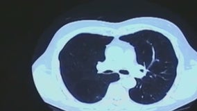 Lung cancer awareness; early screenings encouraged