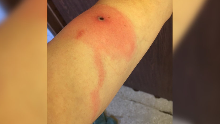 A photo showing a lesion caused by Alaskapox (Courtesy: Alaska Department of Health)