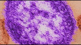 Measles case in Dane County, DHS investigating possible exposures