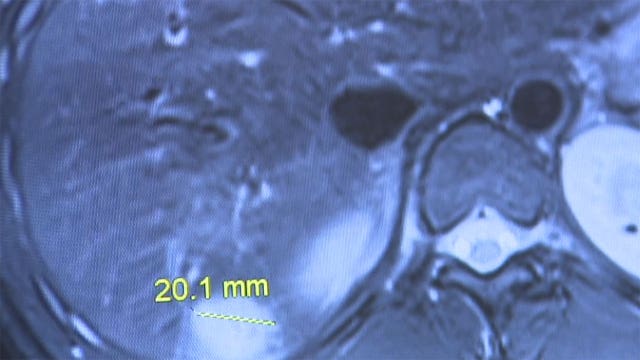 'Troubling medical trend:' Colorectal cancer rising in young people