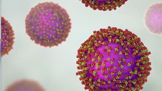Measles in Wisconsin: Health officials address cases, prevention