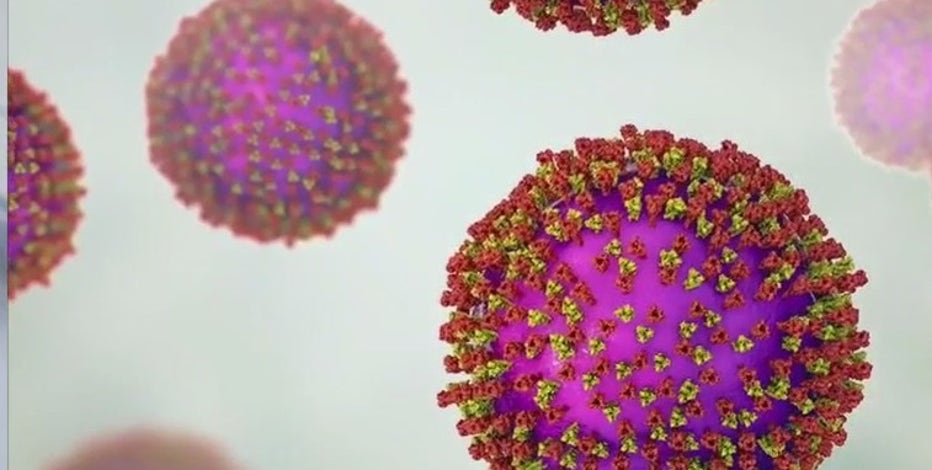 Measles in Wisconsin: DHS confirms state's first cases of 2025