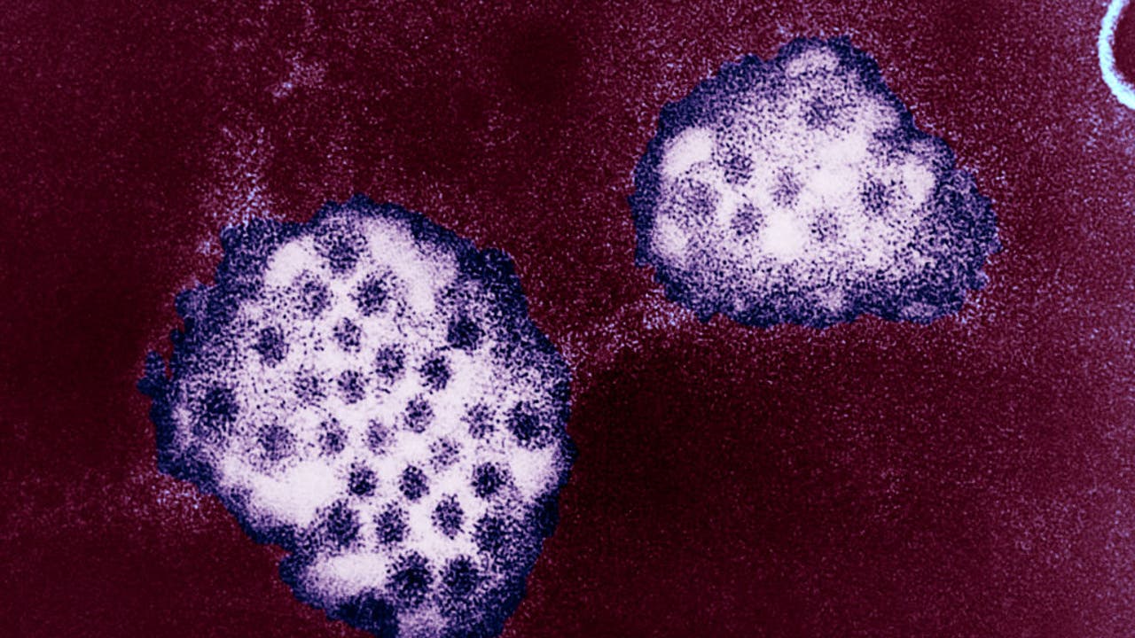 Norovirus cases on the rise in Wisconsin; what you need to know