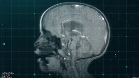 Donated brain thrown out; Children's Wisconsin 'profoundly sorry'