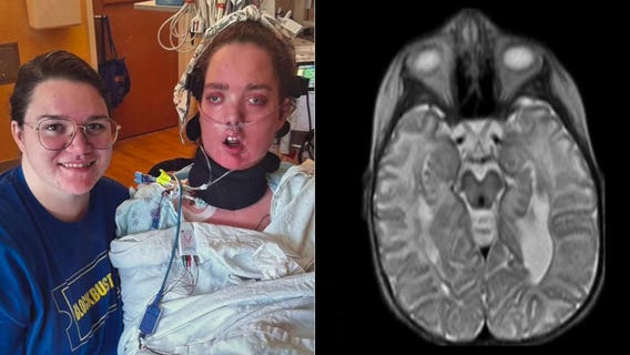 Donated brain thrown out; lawsuit against Children's Wisconsin dismissed