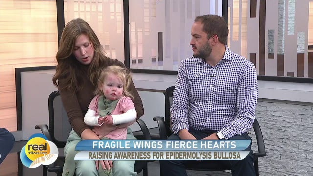 Fragile Wings Fierce Hearts raising awareness for Epidermolysis Bullosa