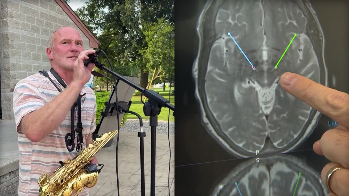Hartland musician uses deep brain stimulation to control Parkinson's tremors