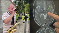 Hartland musician uses deep brain stimulation to control Parkinson's tremors