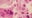 Measles in Central Texas: Kyle resident tests positive