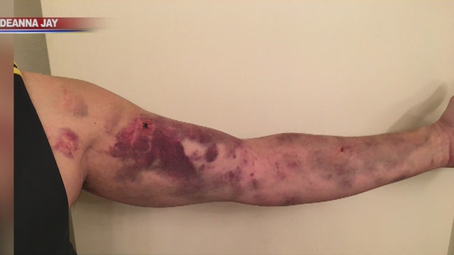 Chandler man's bite at the center of a mystery