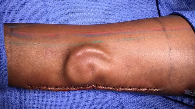 Texas-based soldier has ear re-grown on forearm