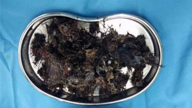 Giant hairball took up two-thirds of girl's stomach