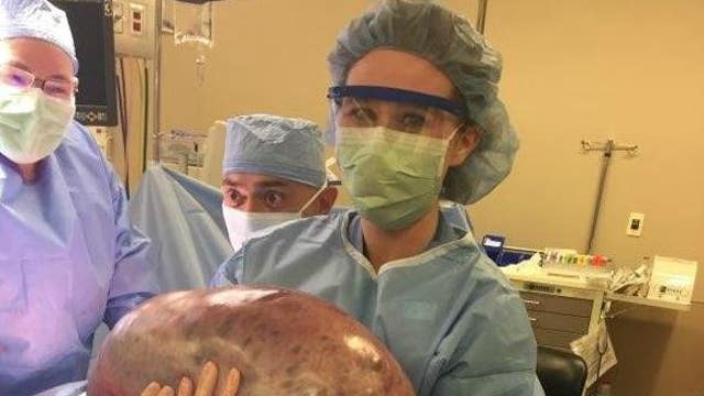 Women relieved 50 pound weight gain was due to benign cyst